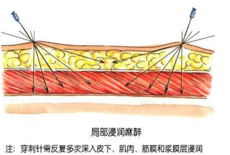 下颌局部麻醉,口腔局部麻醉