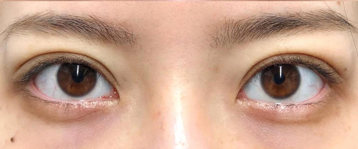 单眼皮肿眼泡去脂肪后适合埋线吗,单眼皮肿眼泡可以割薄一点吗