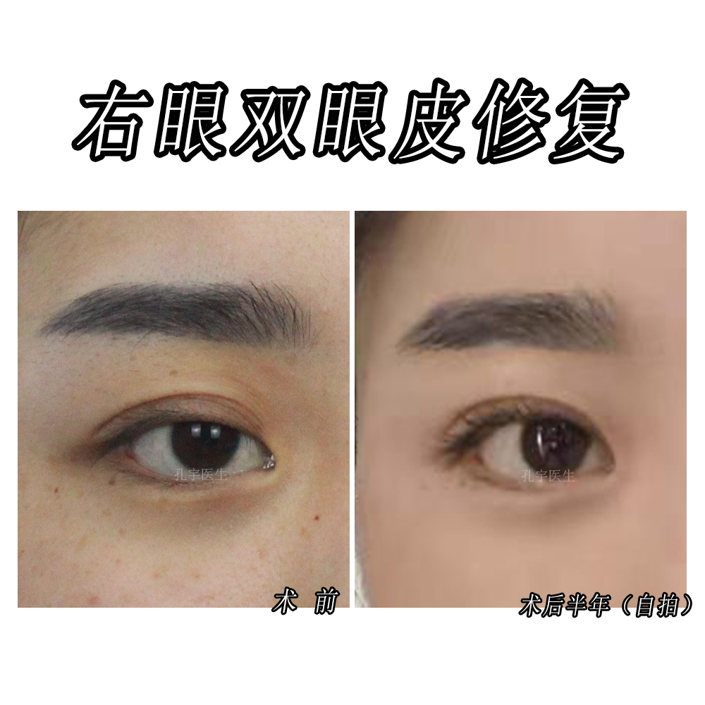 双眼皮修复新乡,姑娘眼部整形后双眼皮变三眼皮