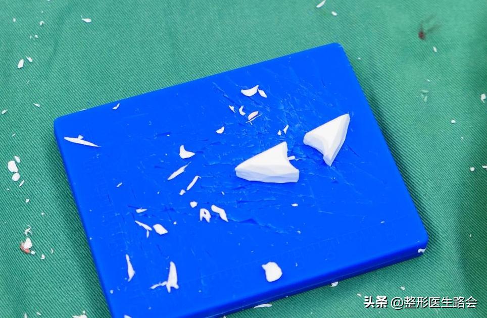 全脸整形记录恢复过程,女孩整形全过程