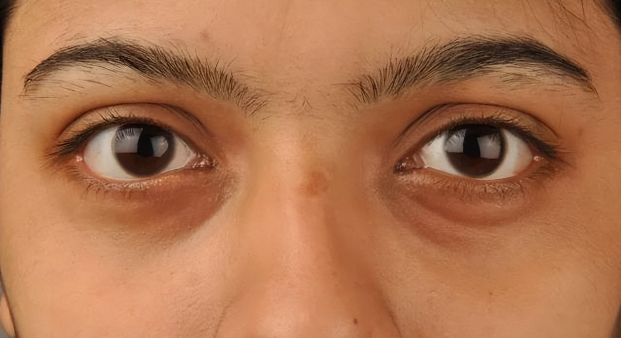 眼窝深邃和眼窝凹陷的区别,为什么眼窝凹陷眉骨颧骨都凸起