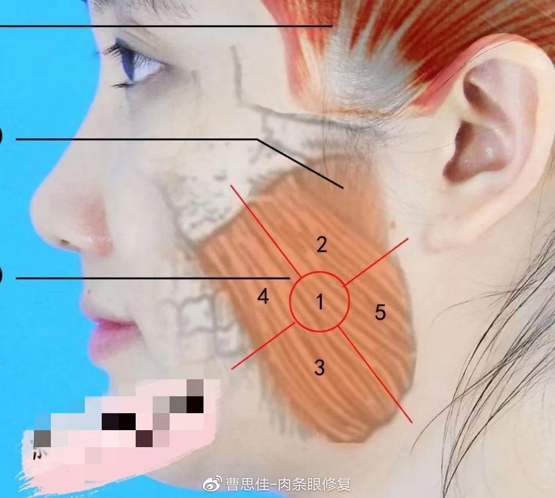 瘦脸针后咬肌为什么更大了,打完瘦脸针咬肌鼓包正常吗