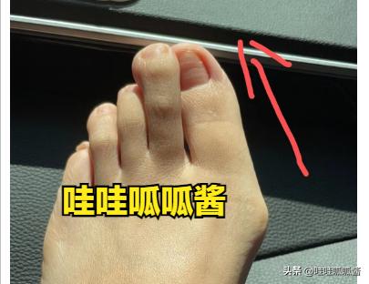 如果发现脚趾头歪了怎么办,脚趾歪了会变严重吗