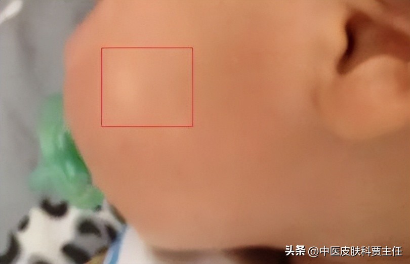 孩子脸上长虫斑，家长以为要驱虫，其实这叫白色糠疹