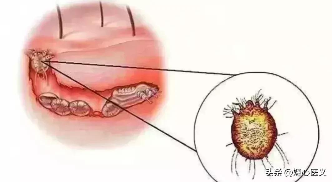 疥疮是什么病的症状啊,疥疮被传染的最初症状
