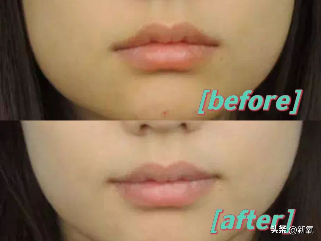 嘴唇薄变丰满,嘴唇变凸变丑怎么办