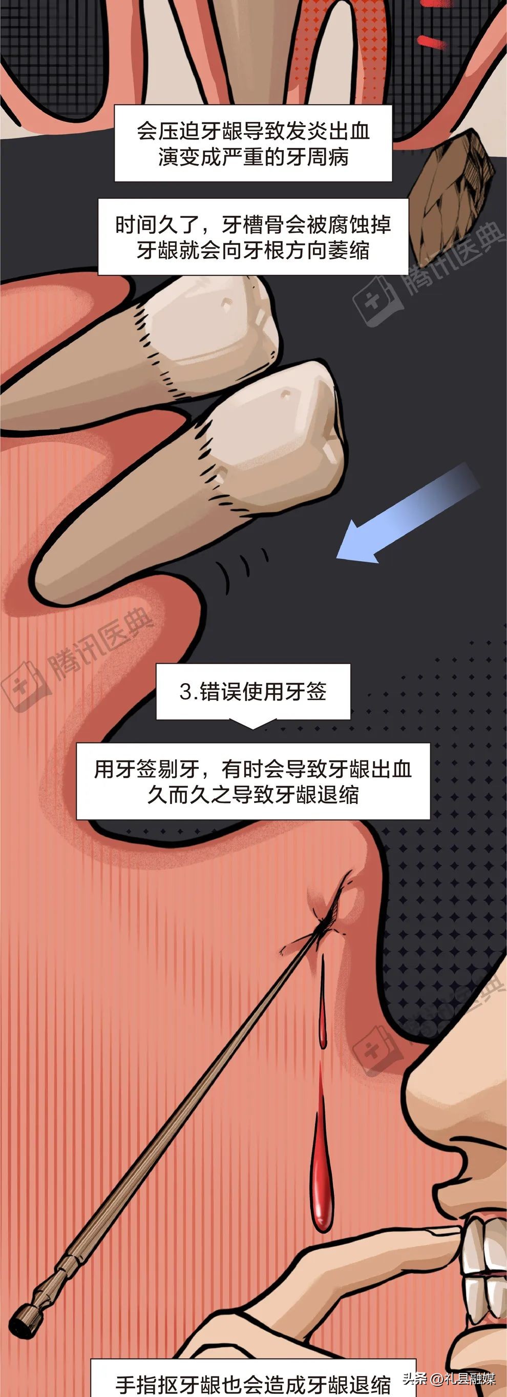 牙缝隙大吃菜就塞牙怎么修复,牙齿吃菜老塞牙怎么办