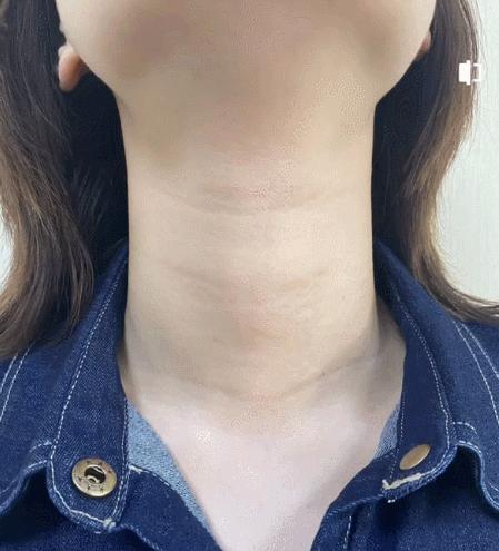 1条颈纹=显老10岁，可怕的颈纹还有救吗？