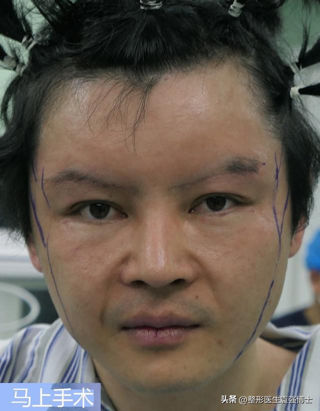 40岁大拉皮的效果,做大拉皮真的可怕吗