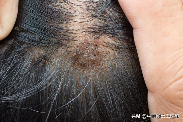脱发严重，再也不用怕！医生教你简单四招，正确搞定掉头发