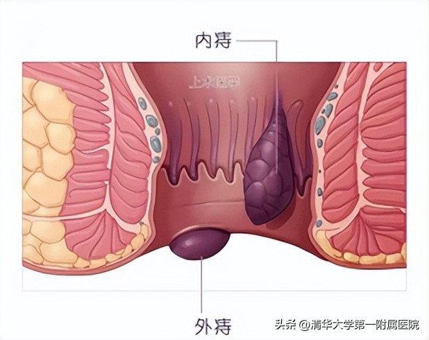 专病门诊知多少丨有“痔”之士，你确定不去看看？