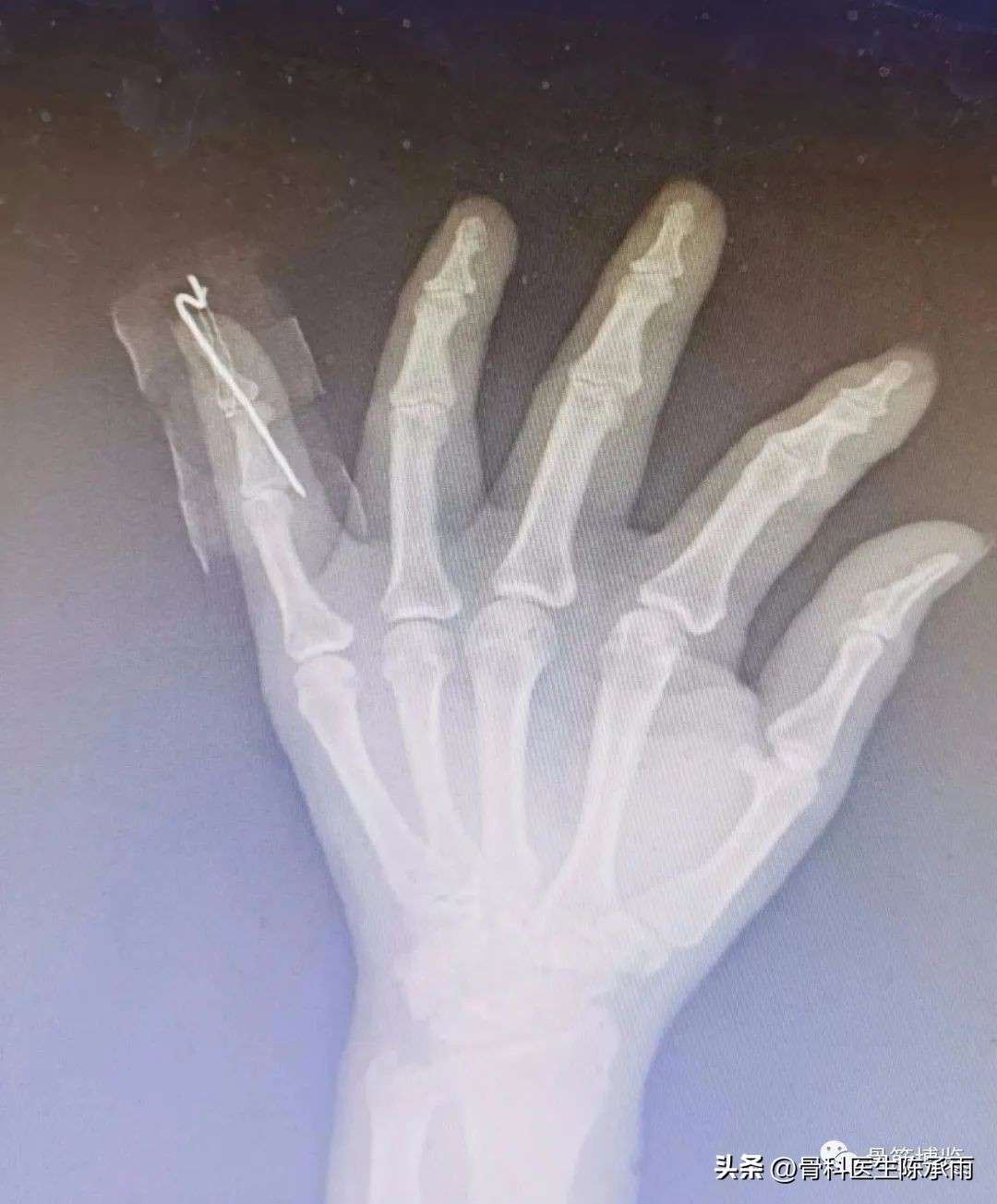 手指出现锤状畸形不要太紧张，看后知道伸肌腱止点断裂重建术