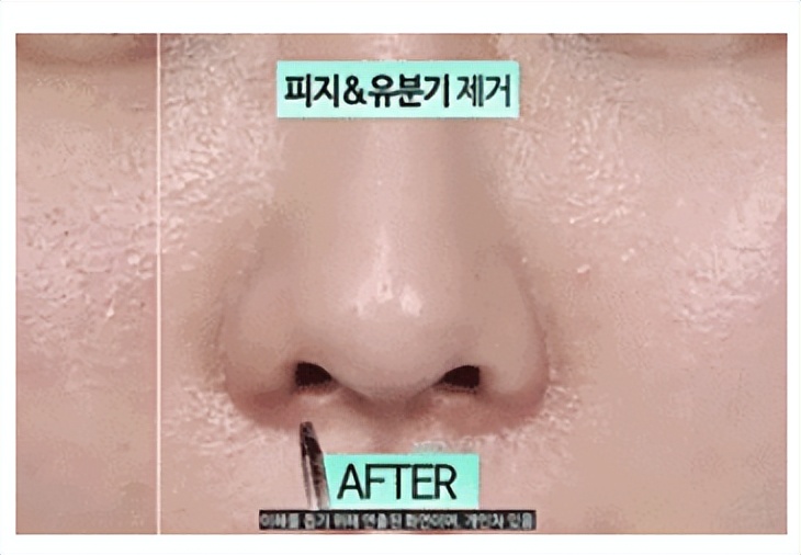 毛孔粗大如何改善治愈系,解决毛孔粗大最有效的方法医美