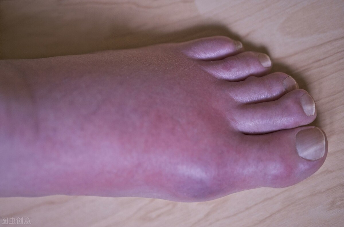 拇外翻手术后脚还在肿是什么原因,脚骨折手术后三个月还肿正常吗