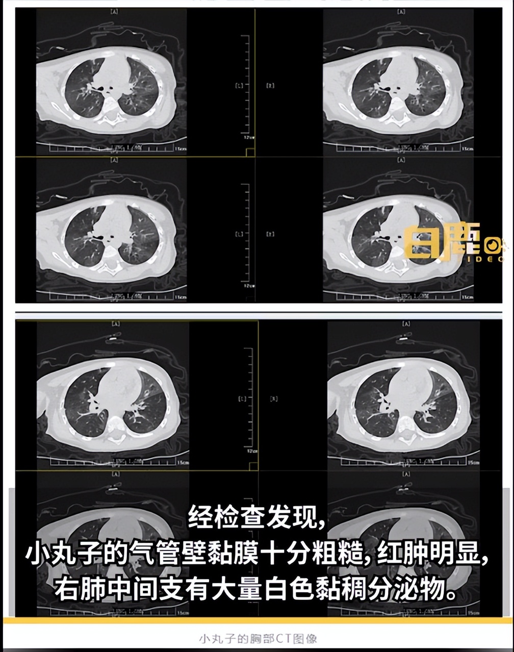 孩子喝奶茶呛了气管案例,小孩子喝珍珠奶茶呛到气管