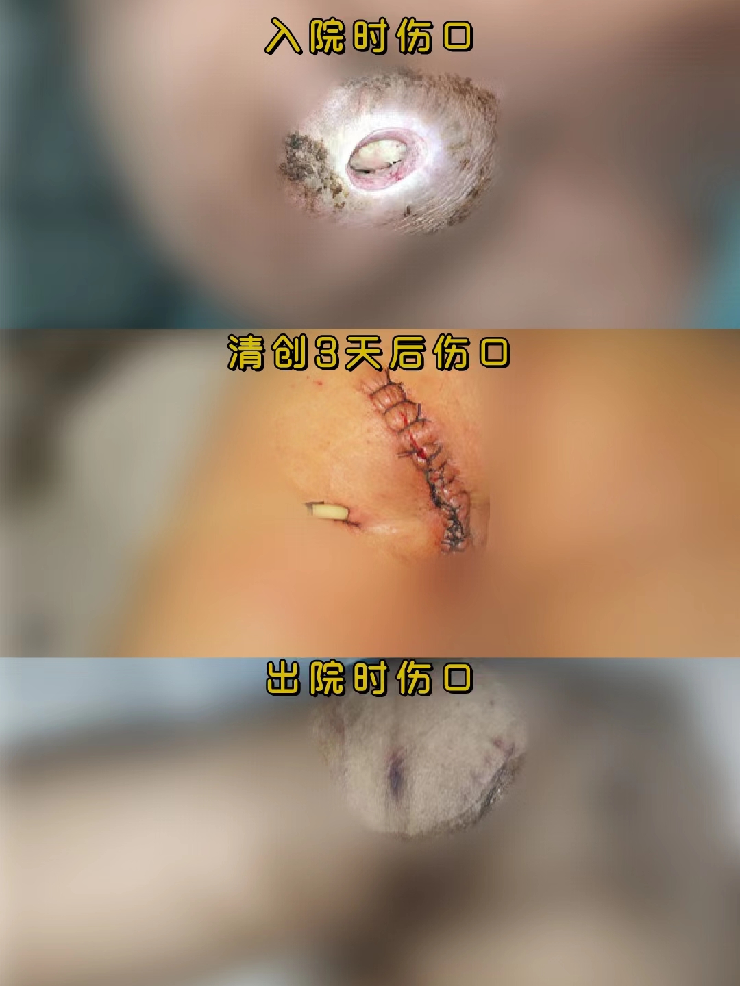 压疮的表现有哪些,什么是压疮怎么治疗