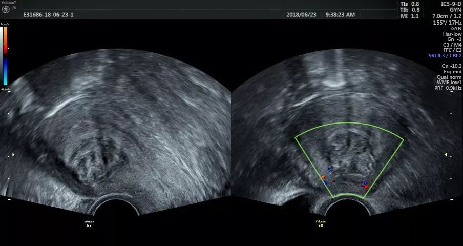 5厘米大的子宫肌瘤需要手术吗,5厘米的子宫肌瘤需要手术吗