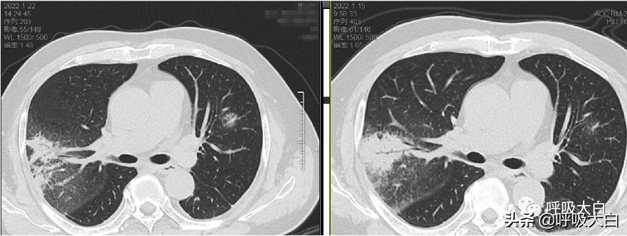 鹦鹉热病例分享,鹦鹉热怎么用药