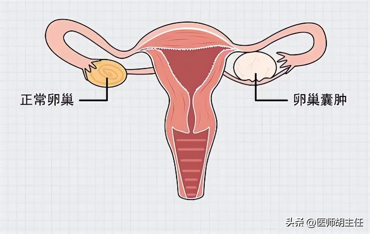 体检肝部囊肿最大2.8怎么办,体检发现肝囊肿肾囊肿