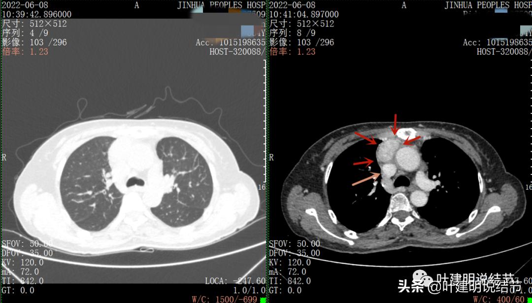 这位老乡，乏力来查，查出这么大个的纵隔肿瘤！会是什么呢？