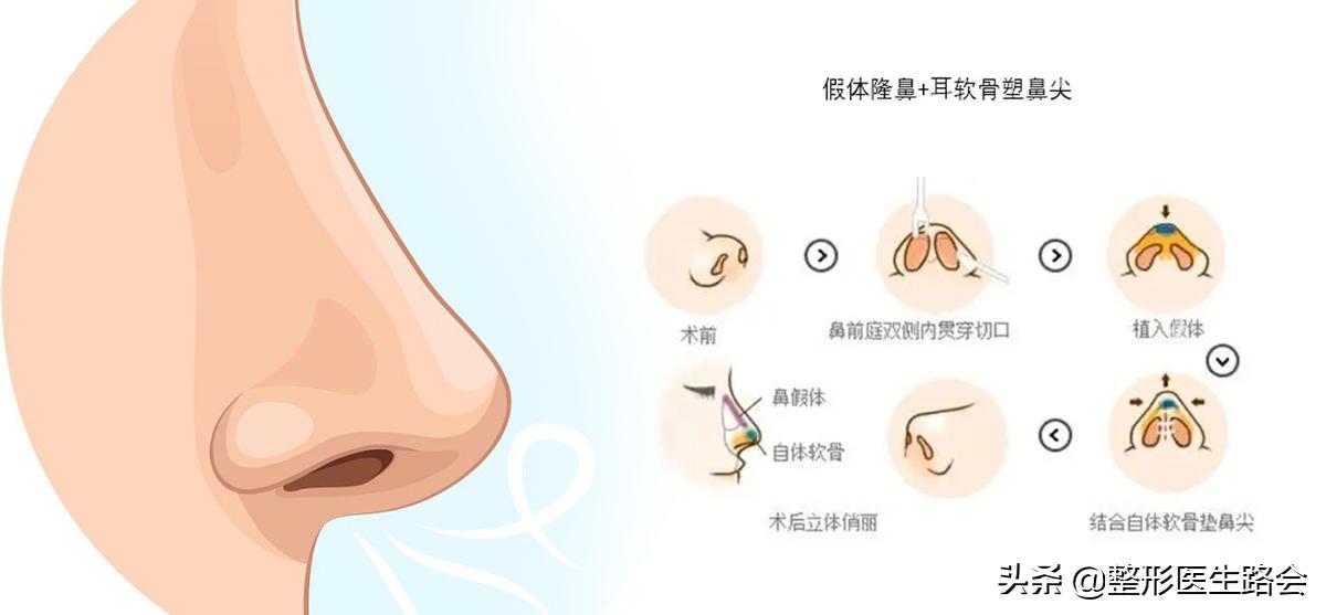 硅胶隆鼻和耳软骨隆鼻效果图,硅胶耳软骨隆鼻副作用