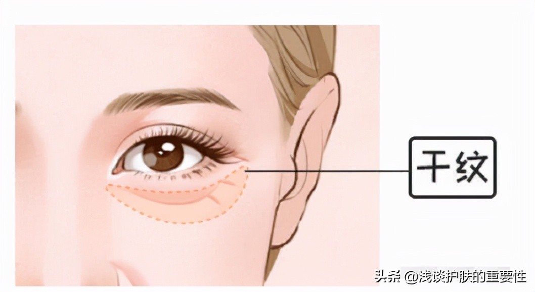 去掉眼纹会不会更显年轻,有眼纹和眼袋哪个更显老