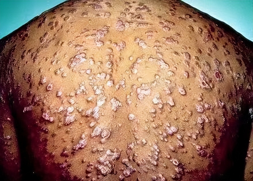 日本梅毒激增,目前最佳治愈梅毒手段