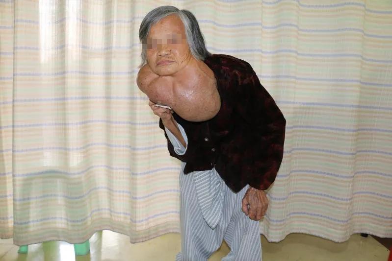 骈拇一：无论出生时脚趾长在一起，还是天生六指，都是多长了东西