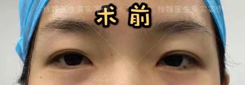 外眼角手术前后对比,做外眼角手术的优势有哪些