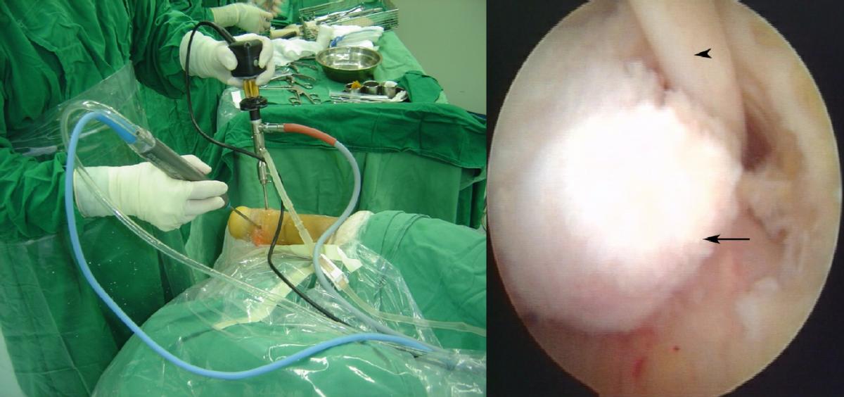 崴脚怎么判断踝关节韧带断裂,没有崴脚脚踝韧带损伤怎么回事