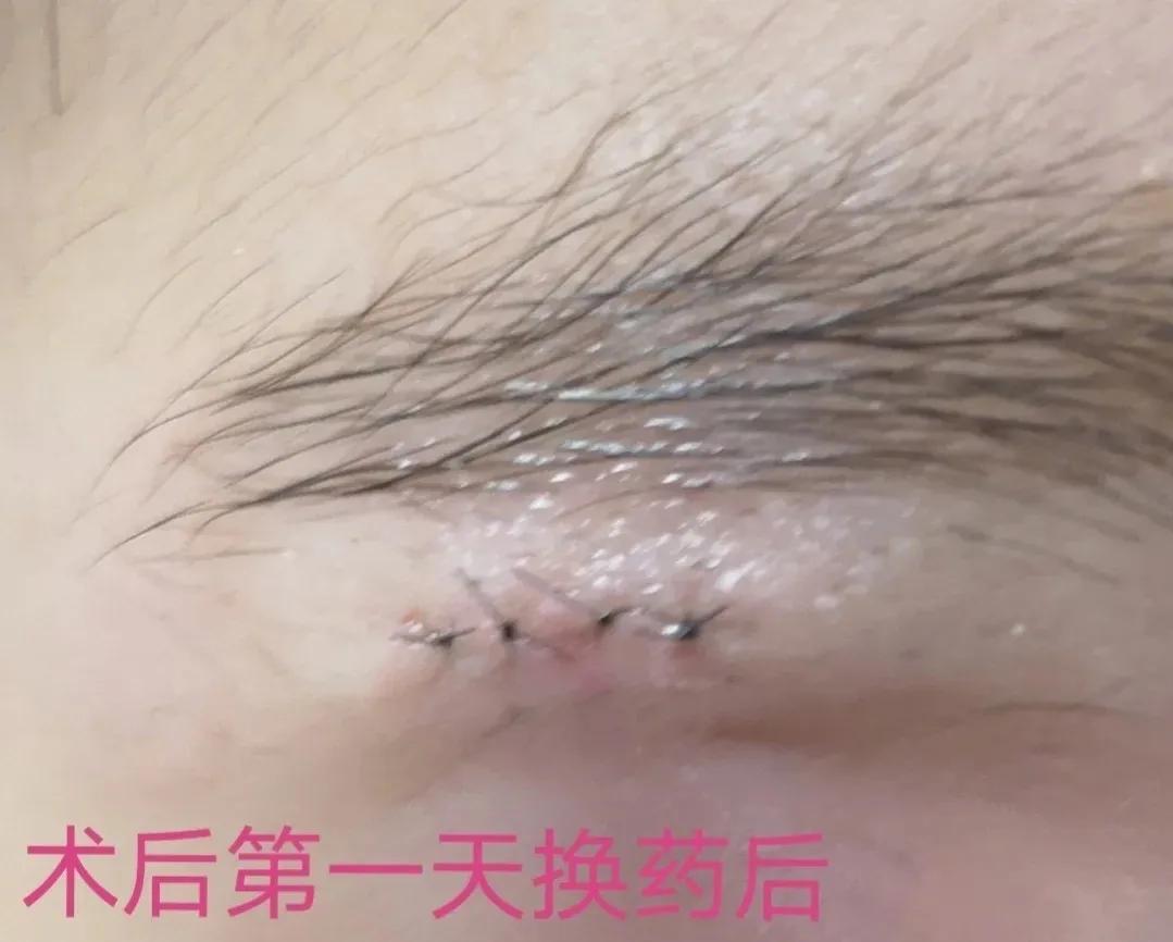 孩子头部皮脂腺囊肿能保守治疗吗,孩子面部皮脂腺囊肿