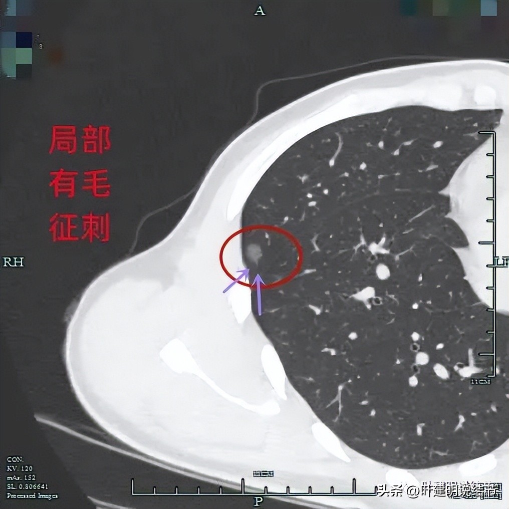 中叶多发微小结节,男性30岁右侧甲状腺单发结节