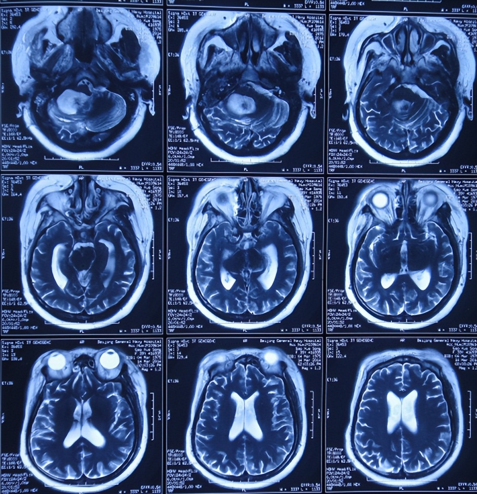 听神经瘤出现脑积水和出血,听神经瘤手术后颅压高症状