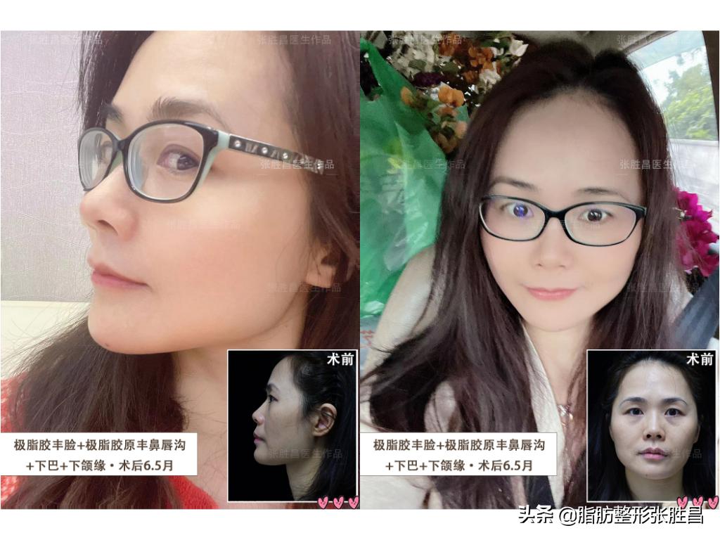 菱形脸颧骨突出怎么改善,颧骨高太阳穴凹陷全脸填充的效果