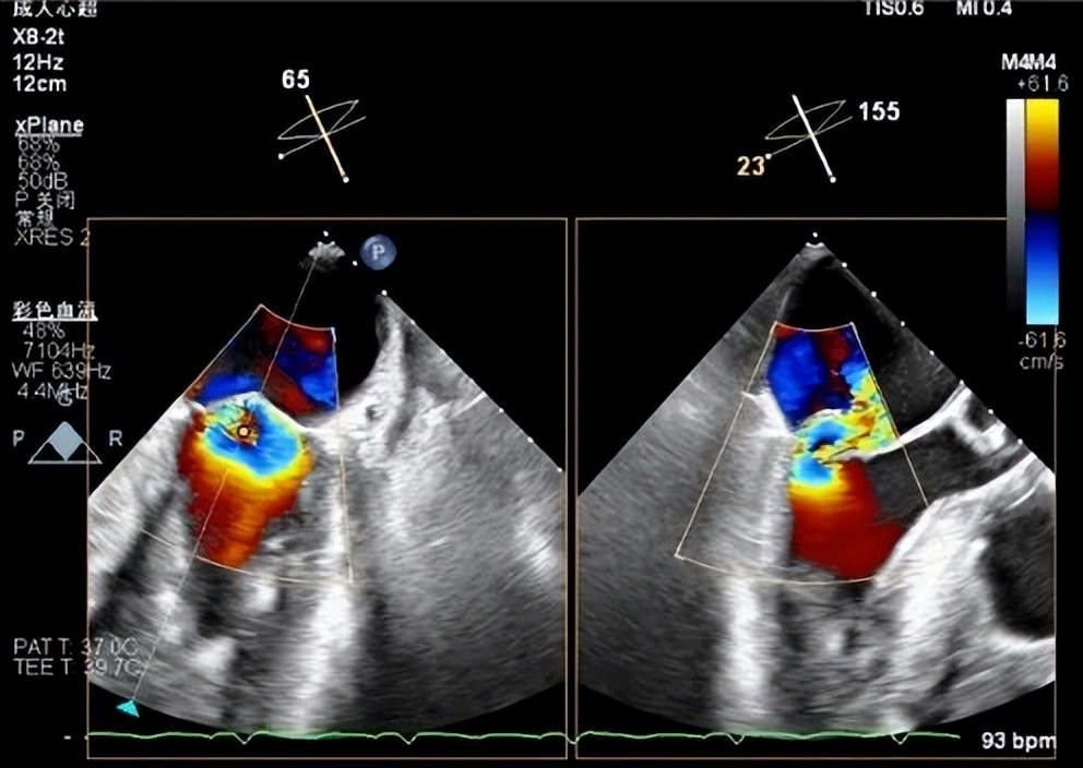 郑州大学第一附属医院心脏瓣膜,新技术治疗心脏瓣膜病