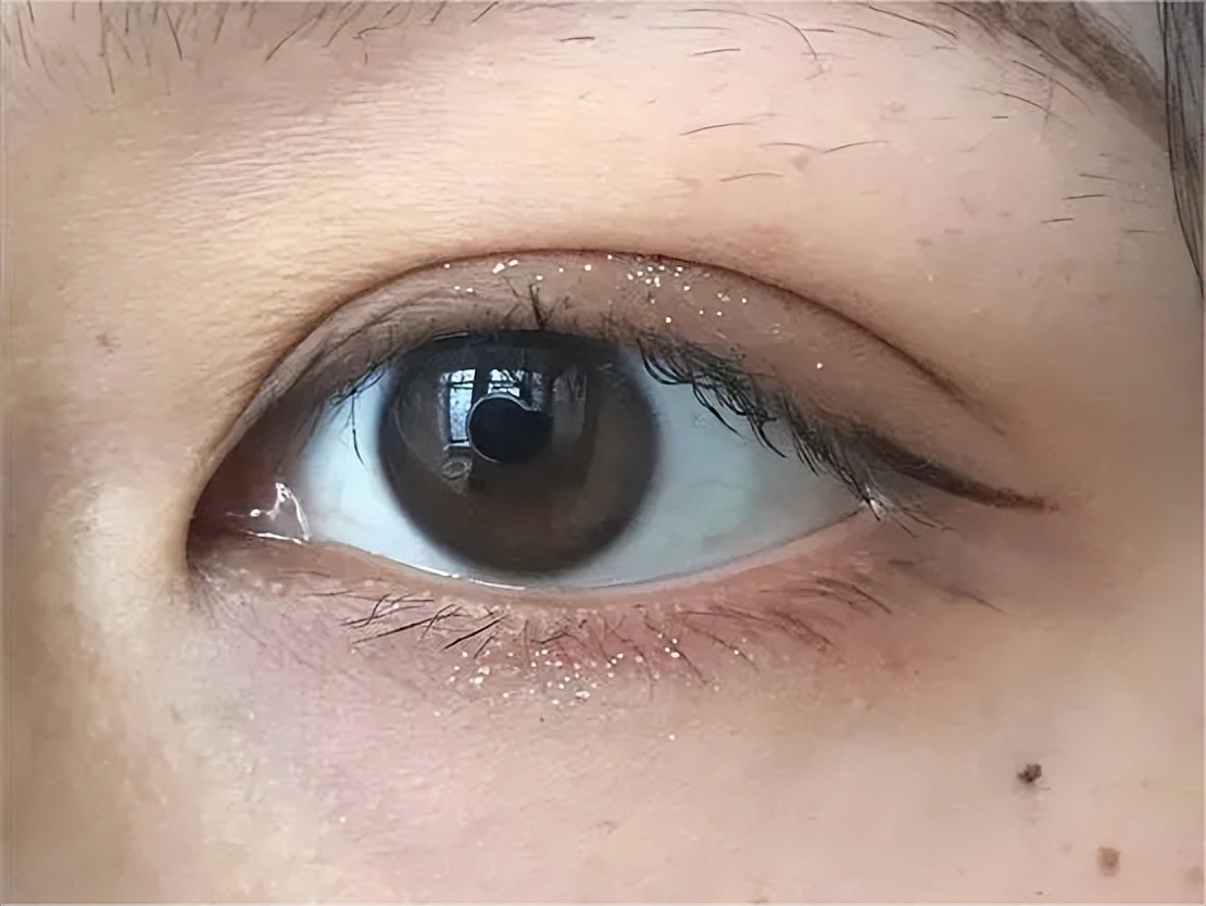 双眼皮手术后眼睛淤紫怎么消除,双眼皮术后眼头紧绷有细纹