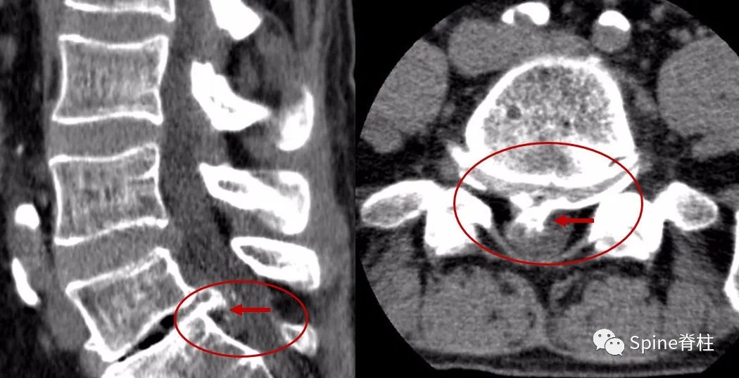 腰椎间盘突出症状表现,腰椎间盘突出症疼痛最佳止痛方法