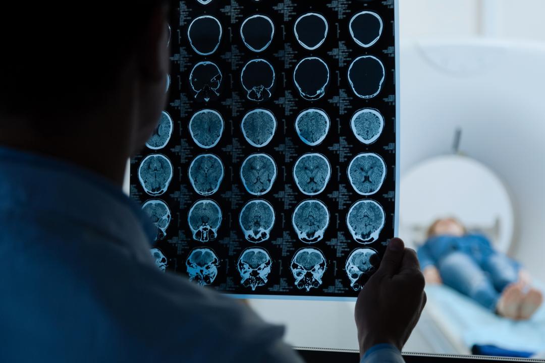 脑动静脉畸形介入手术风险,脑动静脉畸形无症状需要治疗吗