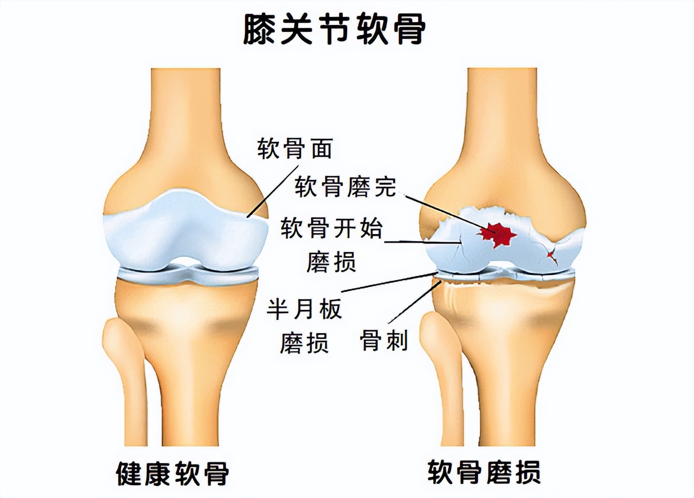 长期坚持跑步男生会变帅吗,男子坚持夜跑15年软骨都要磨没了