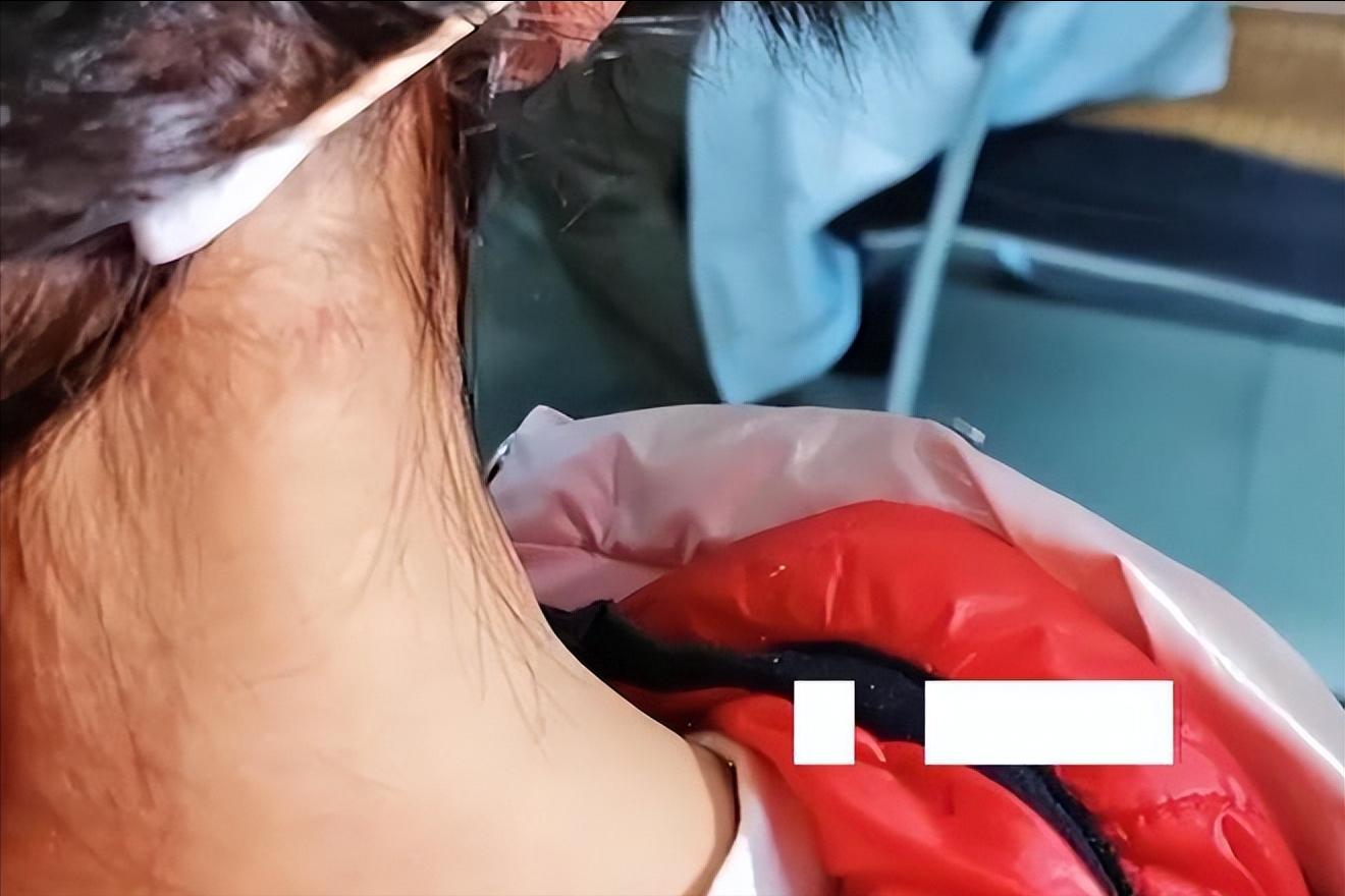 湖南一女孩被女蜱虫咬,女童野外游玩被蜱虫叮咬