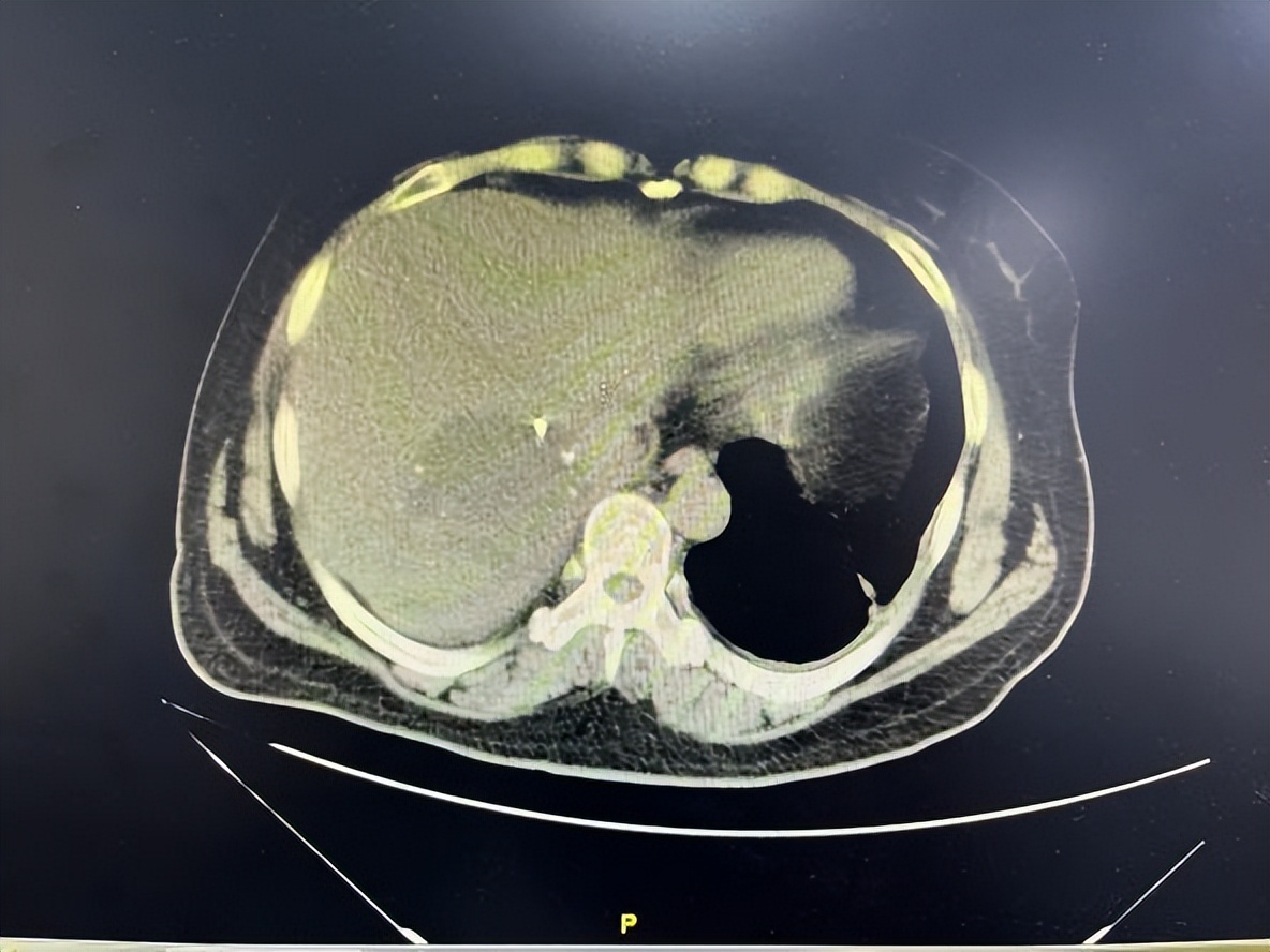 哈医大一院做脑血管瘤,哈医大一院肝脏微创外科