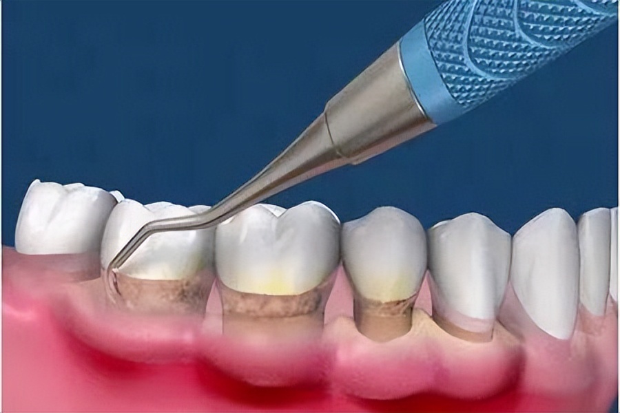 牙结石可以直接抠掉吗,牙结石能直接抠下来吗