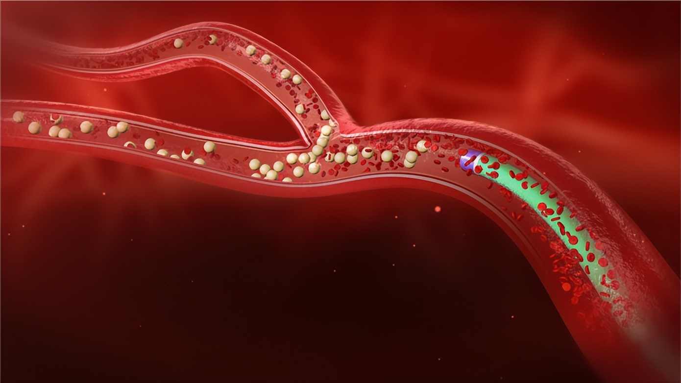 微球介入治疗多发性肝癌视频,微球治疗肝癌能活多久