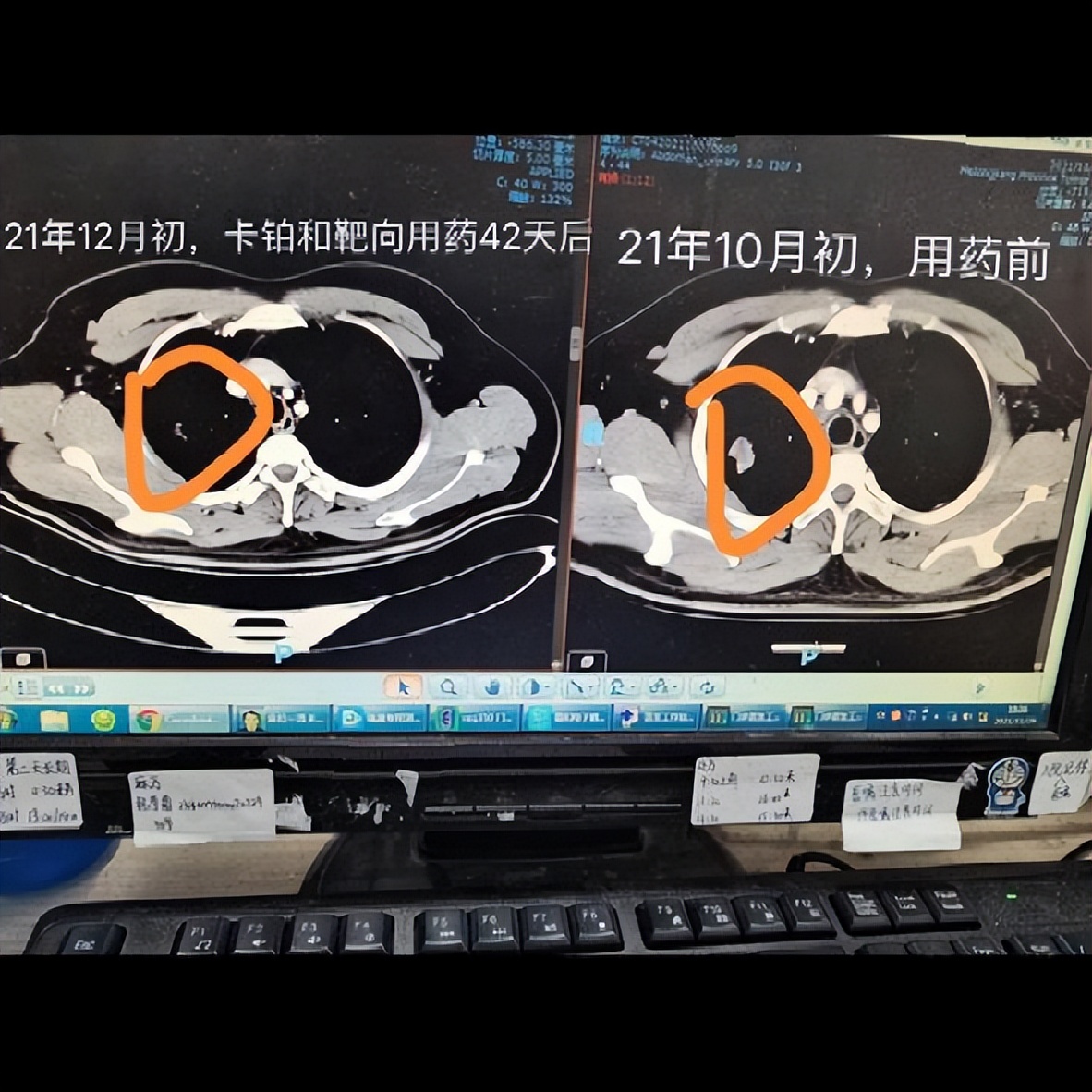 干细胞治疗肺间质纤维化,干细胞治疗肺癌肺鳞癌效果好吗