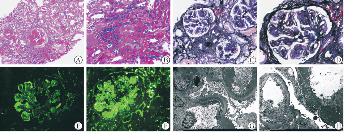 贝利尤单抗狼疮肾炎适应症扩大,治狼疮性肾炎的办法