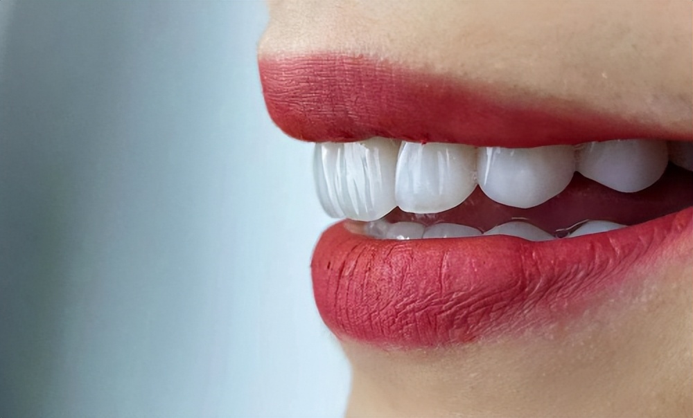 不同瓷块的贴面,不同瓷贴面的对比图