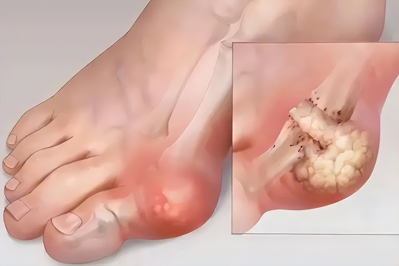 关节prp治疗要打麻药吗,风湿性关节炎prp