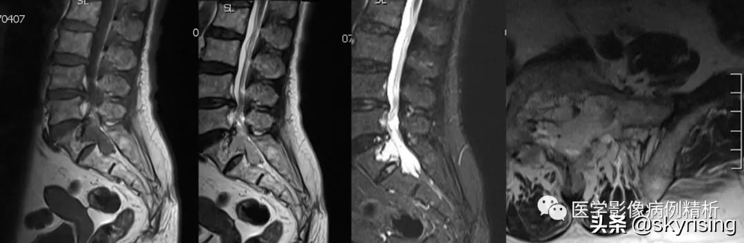 老年女性骶骨受侵椎管骶管内富血供占位影诊思维过程