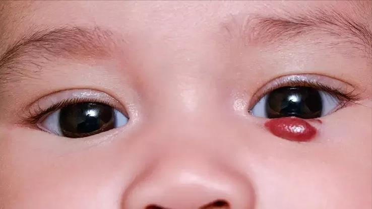 小孩身上的红痣可能是血管瘤,幼儿身上小红点富贵痣竟是血管瘤