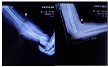 肱骨骨折取钢板怎样恢复,肱骨近端骨折切开复位内固定术